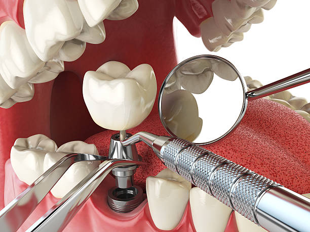 Best Broken or Cracked Tooth Emergency Dentist in Missouri City, TX